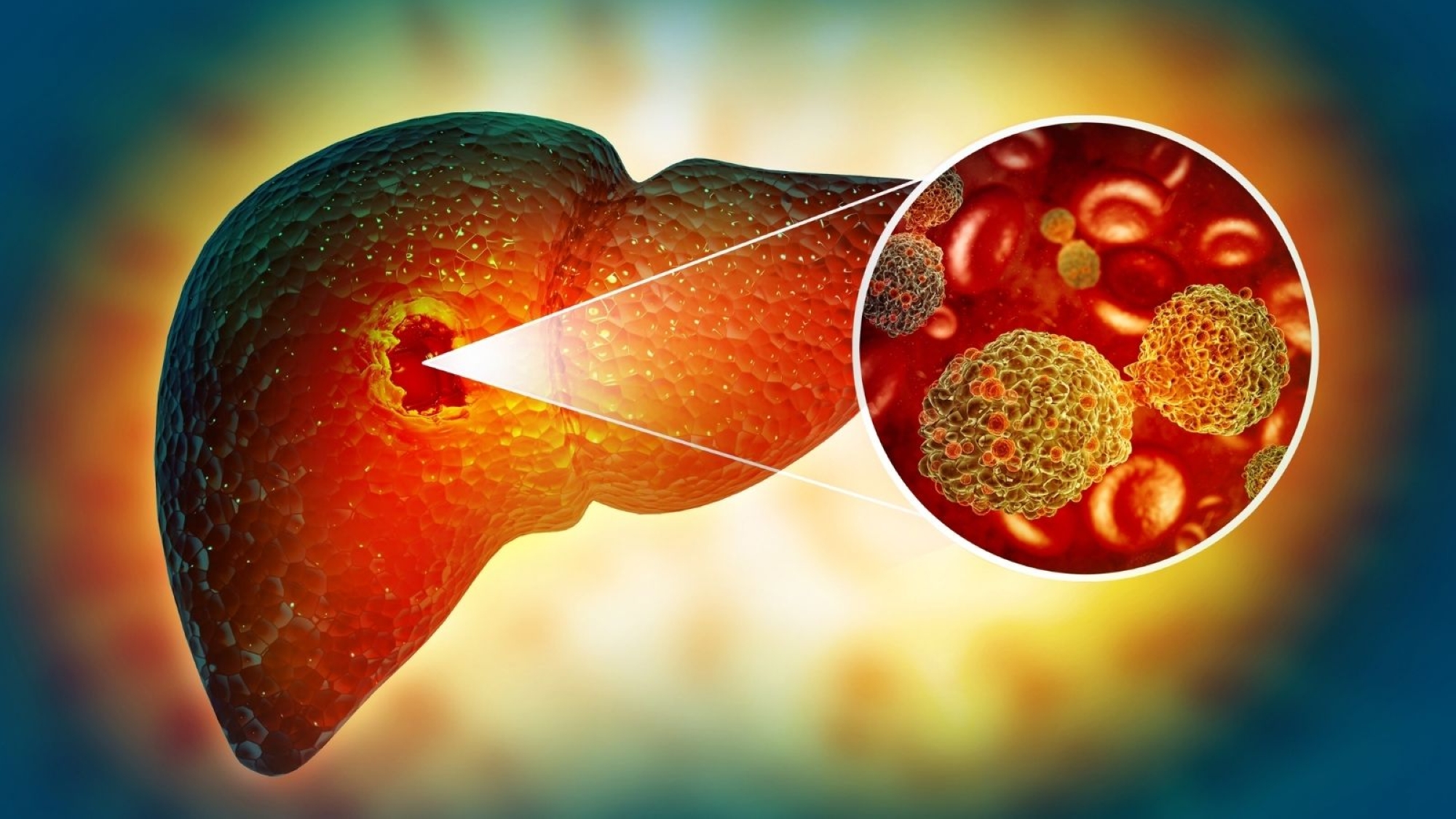 الأغذية الدُهنية تُسرّع الإصابة بسرطان الكبد