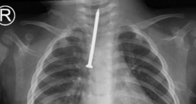 فريق طبي ينقذ رضيعاً ابتلع مسماراً بطول 5 سنتيمترات