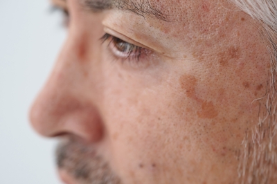 أبرز أسباب الإصابة بفرط تصبُّغ البشرة