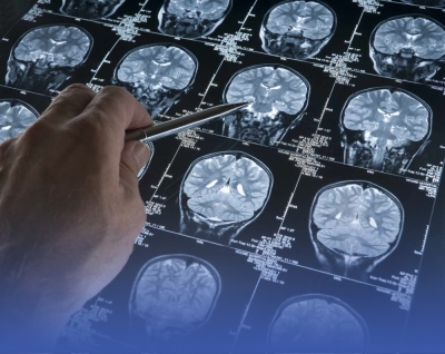 بحث حديث يعيد فتح ملف أدوية ألزهايمر